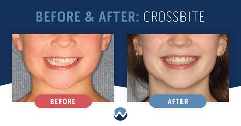 What's a Crossbite? 3 Case Studies Show How We Can Help • Woodhill ...