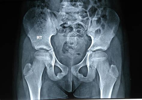 Hip dysplacia xray shoing normal - tastetb