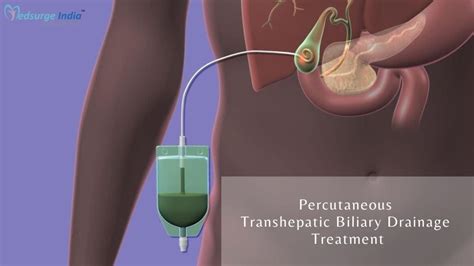 Percutaneous Transhepatic Biliary Drainage Treatment In India ...