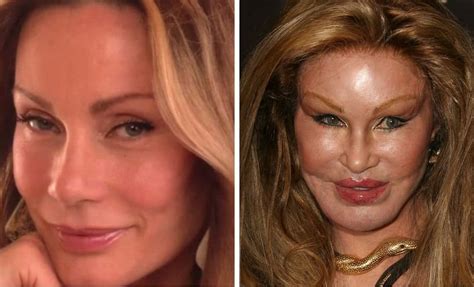 20 Worst Cases Of Celebrity Plastic Surgery Gone Wrong