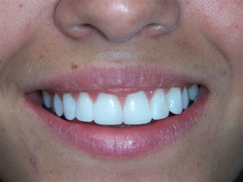 Teeth Bonding Before And After Photos - TeethWalls