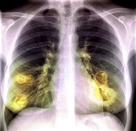 Lung Lesions, X-ray Photograph by Du Cane Medical Imaging Ltd - Fine ...