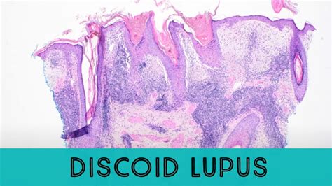 Discoid Lupus Erythematosus under the microscope (pathology dermatology ...