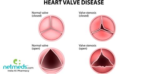 Causes, symptômes et traitement de la maladie valvulaire cardiaque