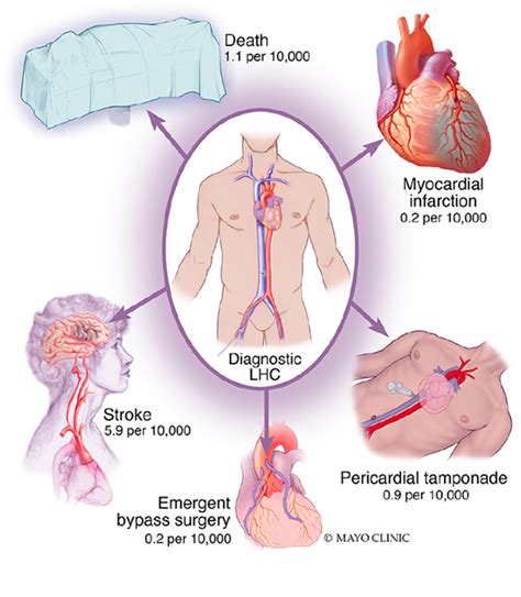 Safety and Risk of Major Complications With Diagnostic Cardiac ...