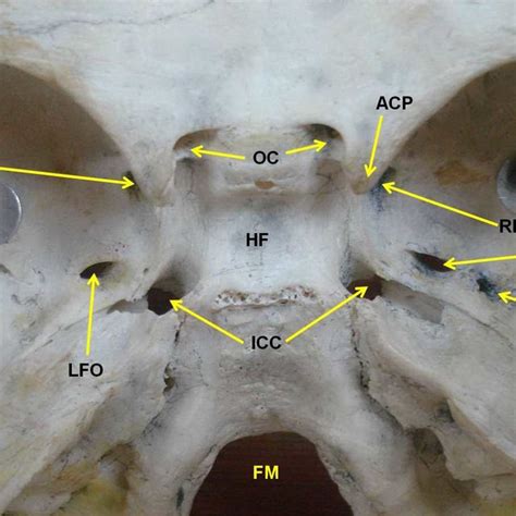 Photograph of the middle cranial fossa showing confluent foramen ovale ...