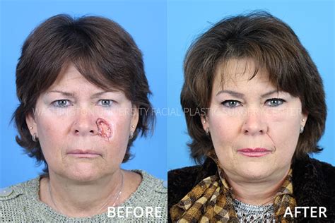 Cheek Reconstruction | Facial Plastic Surgery Center | Washington ...