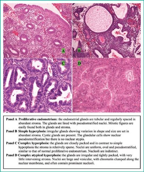 Atypical Endometrial Hyperplasia : (PDF) Atypical Endometrial ...