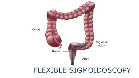 Flexible Sigmoidoscopy – Torrance Digestive Disease Institute