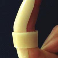 (PDF) Volar Plate Avulsion Injury