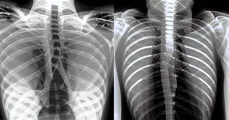 Could Stable Diffusion Solve a Gap in Medical Imaging Data?