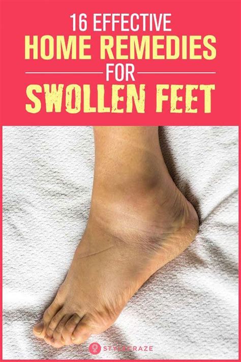 16 Effective Home Remedies For Swollen Feet #NaturalRemediesForSickness ...