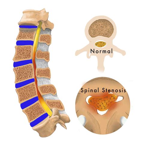 Spinal Stenosis