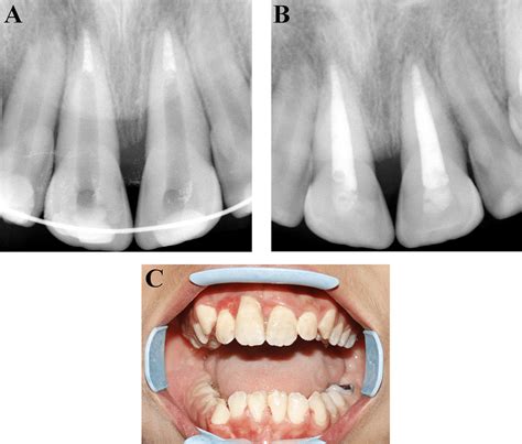 (A, B) endodontic treatment of the maxillary central incisors (C), the ...