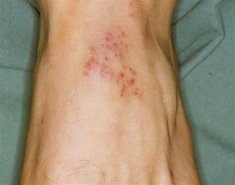 Petechial Rash | Good Health