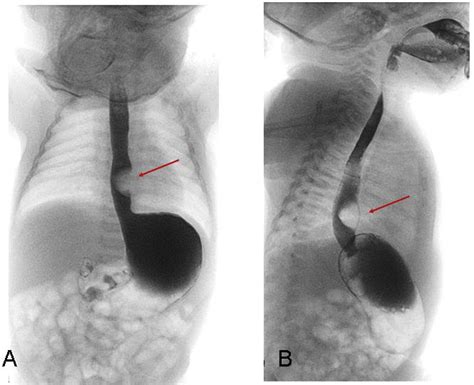 Esophageal duplication cyst in newborn - Pediatrics & Neonatology