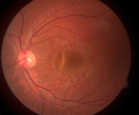 Choroidal Hemangioma - Retina Image Bank