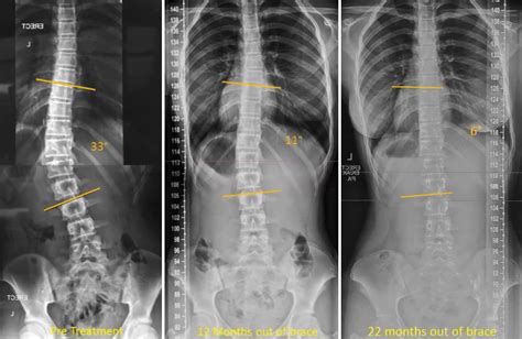 Scoliosis Brace