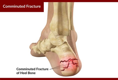 Calcaneus Fracture or Broken Heel|Treatment|Recovery|Symptoms|Types|Causes