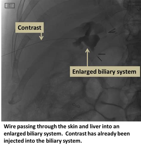 Biliary Drainage - Interventional Radiology | UCLA Health