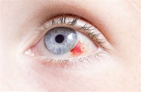 What Causes Broken Blood Vessels in the Eye? | Stony Plain