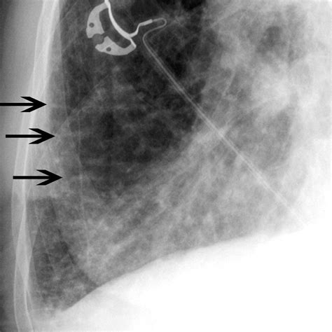 Heart Failure (HF) - Cardiovascular Disorders - MSD Manual Professional ...