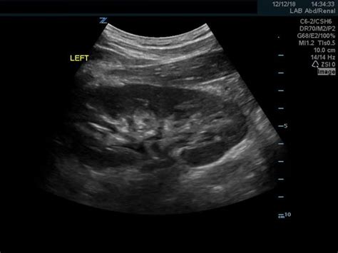 Normal Kidney Ultrasound