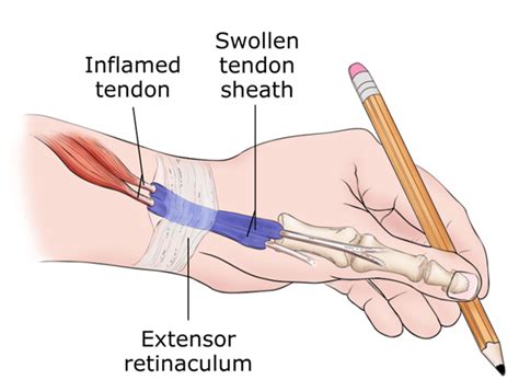 Hand Surgery for De Quervain's Tenosynovitis