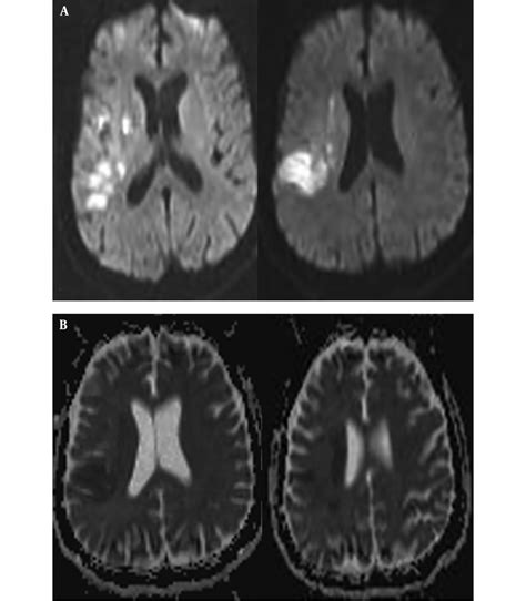 Diffusion restriction areas observed in DWI of patient 1. | Download ...