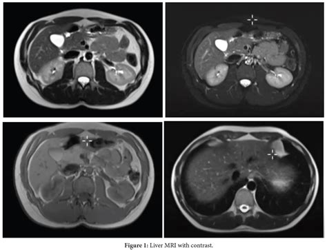 Liver MRI with Contrast: A Comprehensive Guide to the Procedure and ...