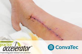 Surgical Wound Complications | WoundSource