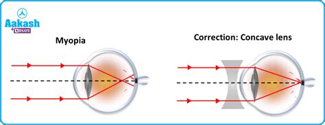 Concave Lens: Uses, Formula, Diagram & Image Formation | AESL