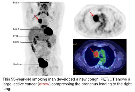 Pet Scan Cancer