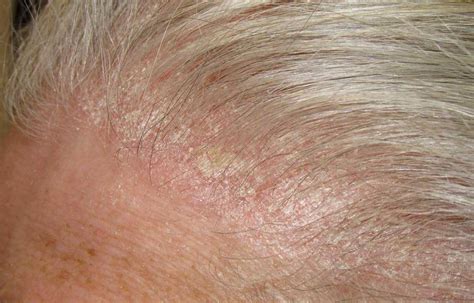 How To Treat A Scabby Scalp – DS Healthcare Group