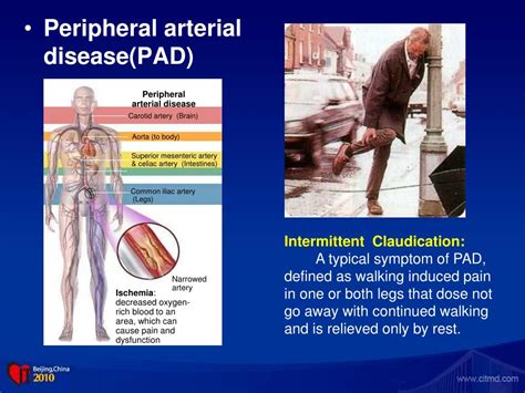 PPT - Exercise Therapy For Intermittent Claudication PowerPoint ...