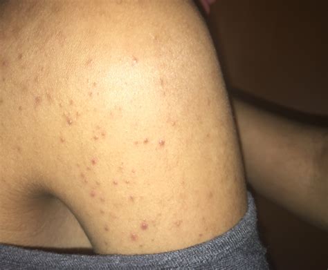 Pesky acne on shoulders hALP - Back/Body/Neck acne - Acne.org Community