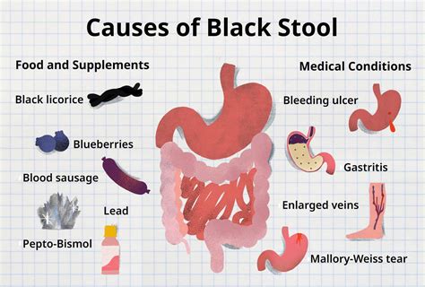 Why Is My Poop Black? Causes and Treatments for Tarry Stool (2023)