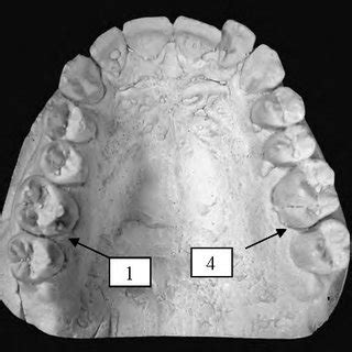 A rare instance of two paramolar tubercles on a maxillary left second ...