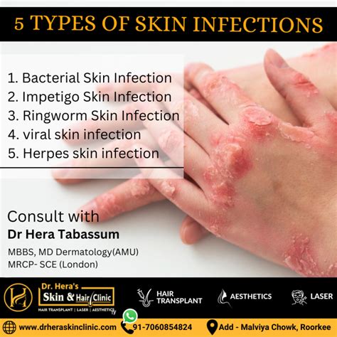 What are the 5 types of skin infections? - Dermatologist in Roorkee