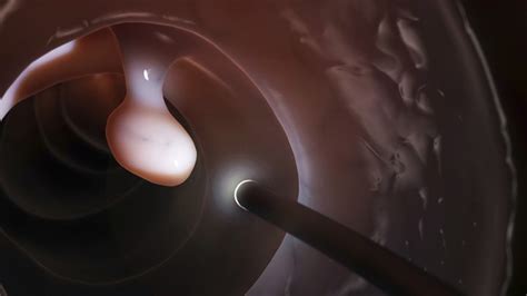 New Colon Polyp Removal Method May Be Easier on Patients - Everyday Health