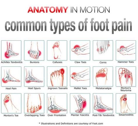 Common types of foot pain - Advance European Medicare Center