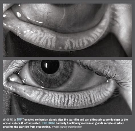 Meibomian Gland Dysfunction (MGD) | Atasca Eye Center