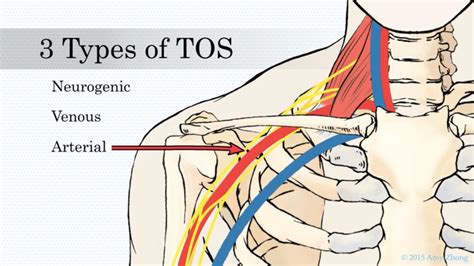 Nerve Block Treatment for Thoracic Outlet Syndrome (TOS) - Johns ...