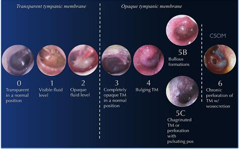 Figure 1 from AIDS FOR OTOLARYNGOLOGISTS DIAGNOSTIC EVALUATION OF ...