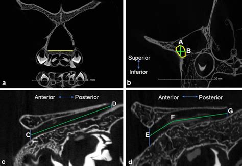 Measurements of the infraorbital canal. a Coronal section indicating ...