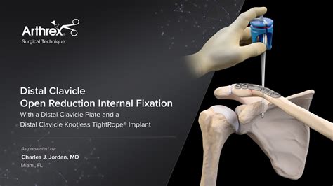 Arthrex - Distal Clavicle Open Reduction Internal Fixation With a ...