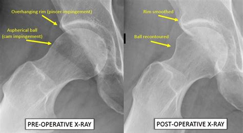 Hip pain xray normal - holfaspen