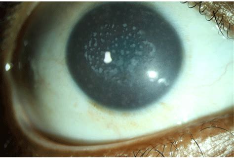 Macular Dystrophy Corneal