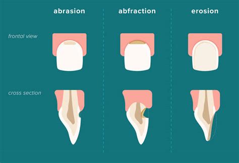 Best Tooth Erosion Treatment | Tooth Abrasion Dental Treatment