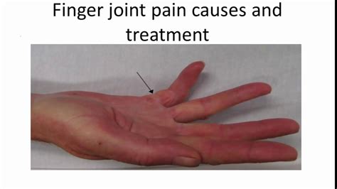 Finger joint pain causes and treatment - YouTube